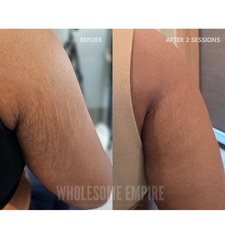 Stretch marks on the back of an arm, before and after two sessions