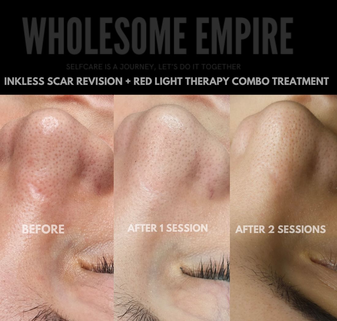 A scar before treatment, after one session and after two sessions of inkless revision with red light therapy