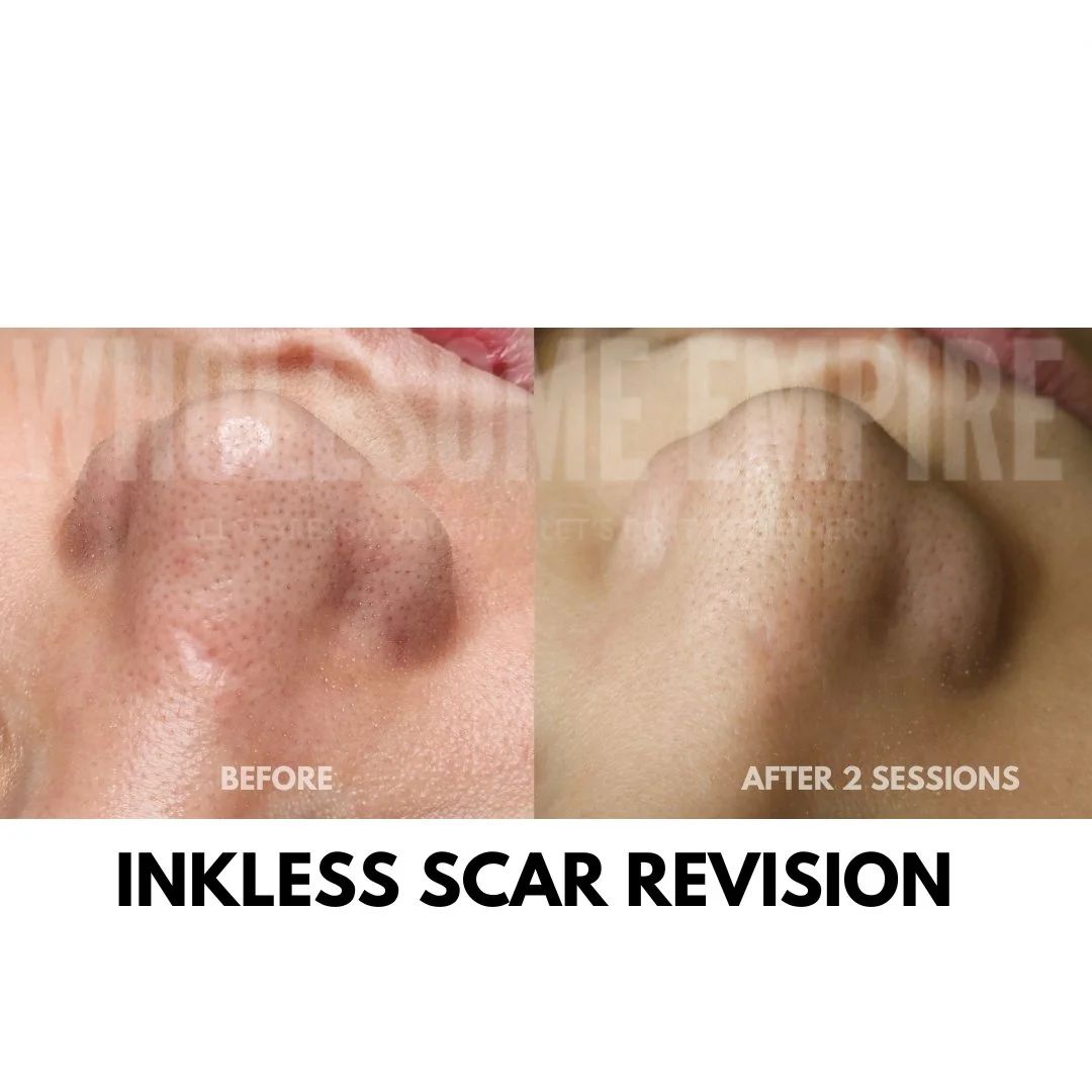 A scar before and after two sessions of inkless scar revision