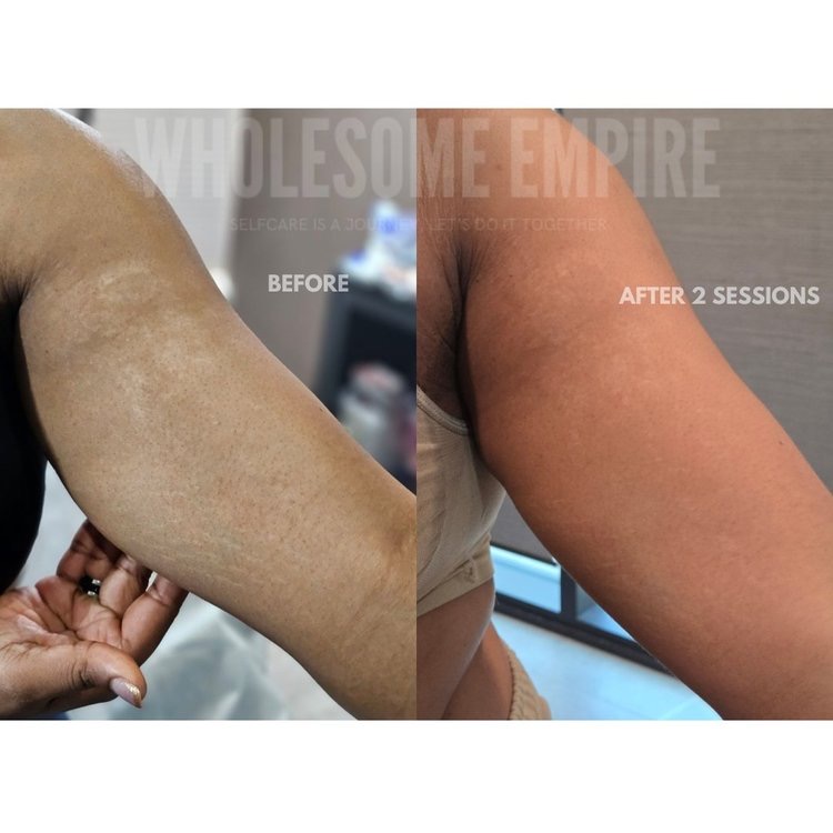 Stretch marks on an upper arm, before and after two sessions