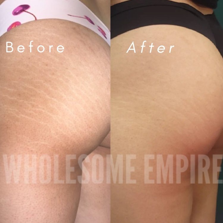 Stretch marks on the hip and glute, before and after