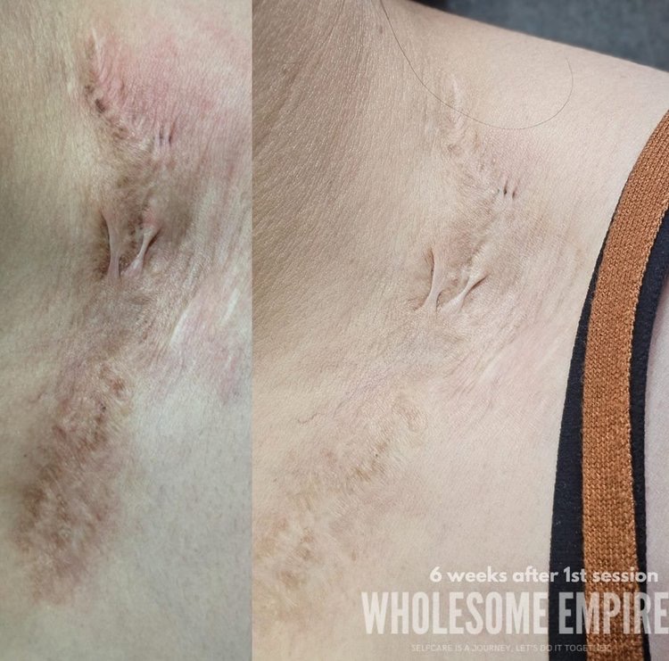 Raised scarring, before and six weeks after the first session
