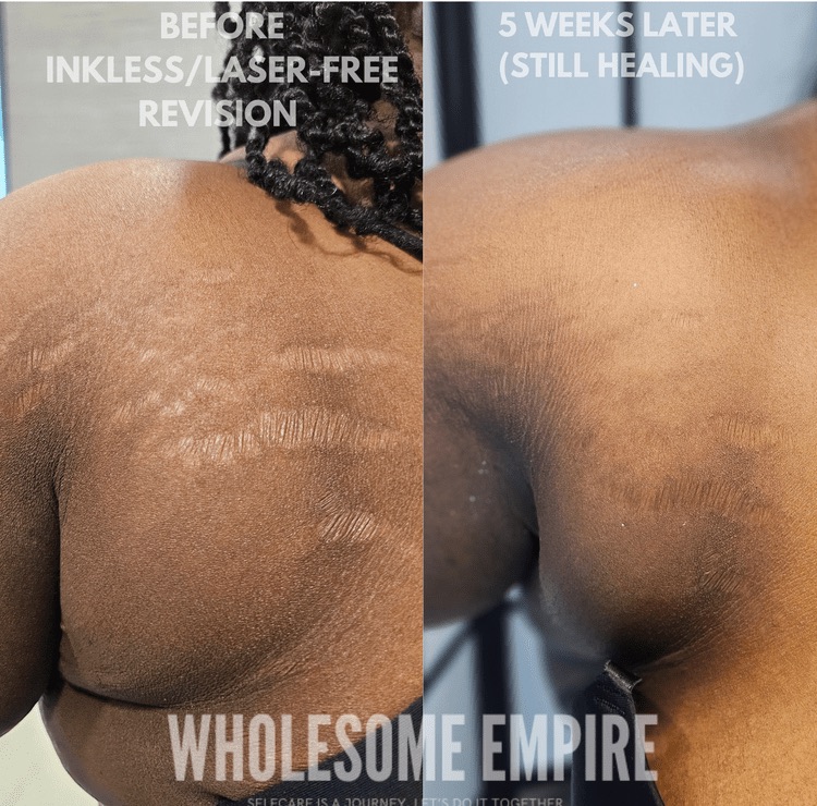 Shoulder stretch marks before inkless revision and five weeks later