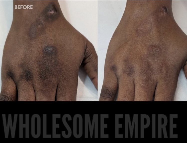 Scarring on the back of a hand, before and after
