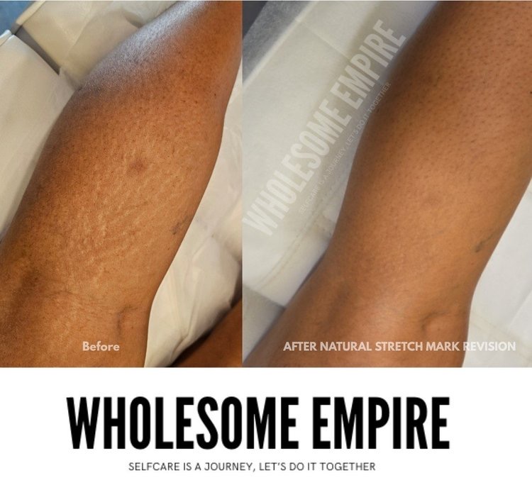 Stretch marks on darker skin, before and after natural stretch mark revision