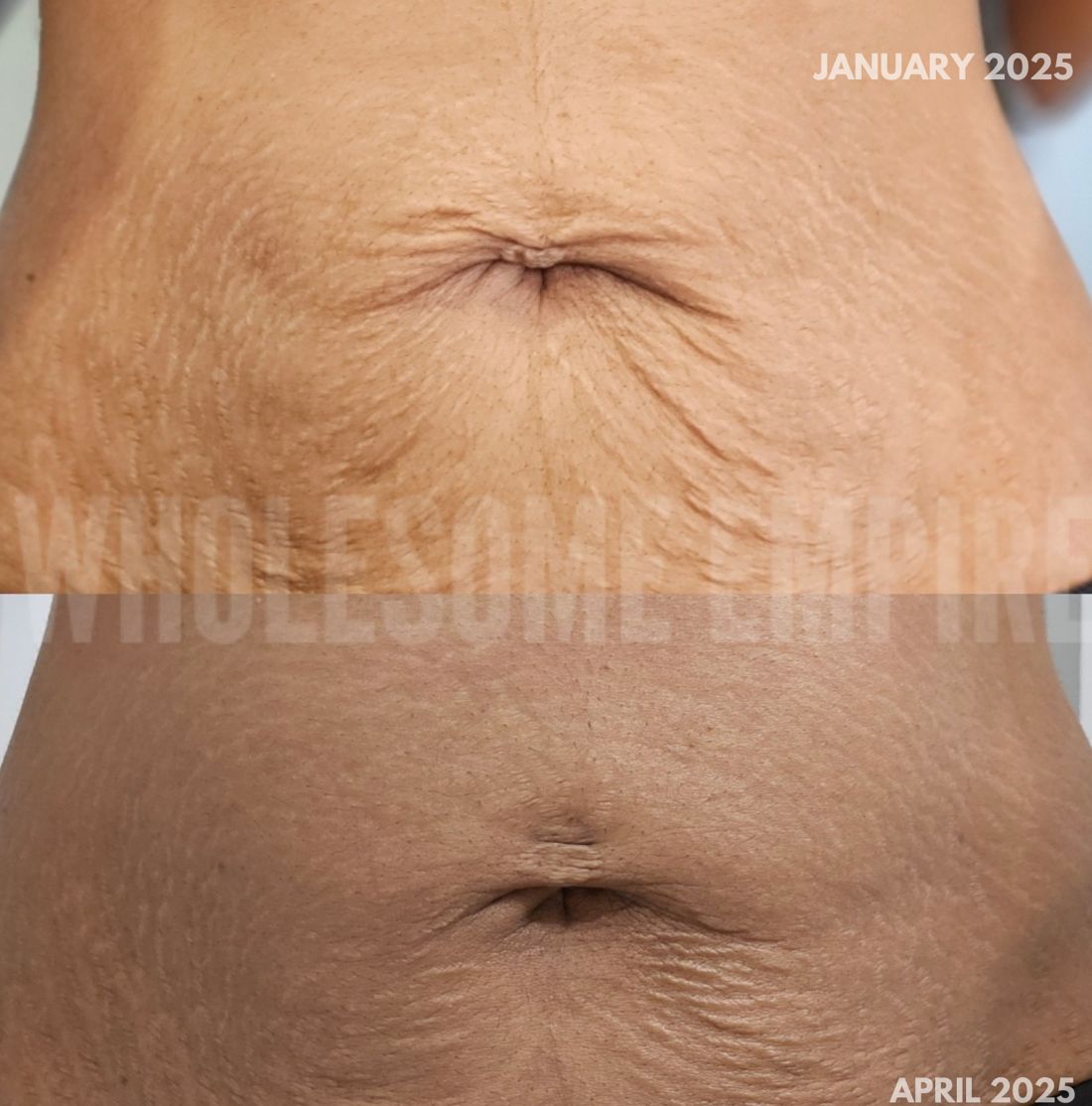 Abdominal stretch marks in January 2025 and again in April 2025